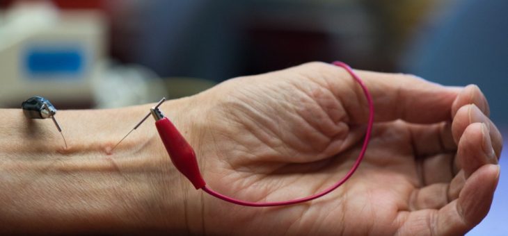 Acupuncture may Reduce High Blood Pressure